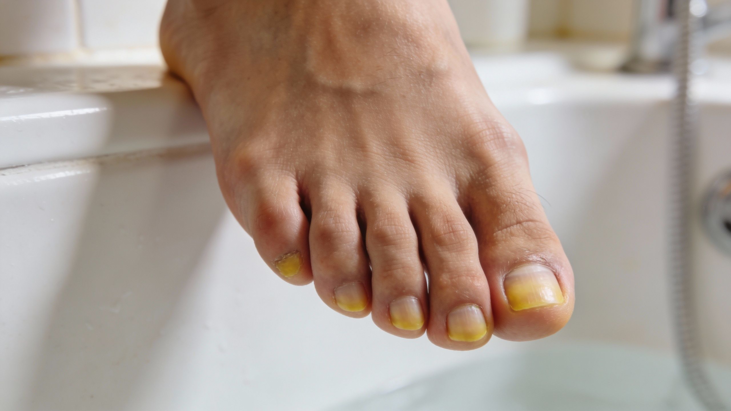 Ongles des pieds jaunes : comprendre et agir